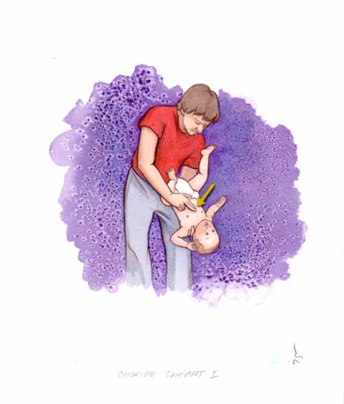 Illustration- Clearing infant airway 1