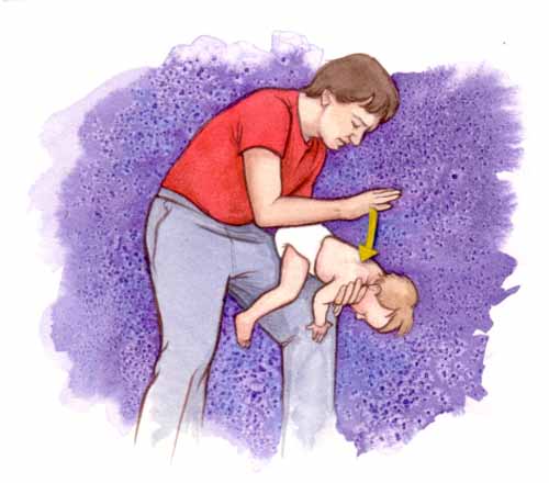 Illustration- Clearing infant airway 2